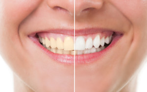 Dicas para manter e restaurar o esmalte dos dentes